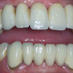Prótesis de metal porcelana sobre implantes dentales