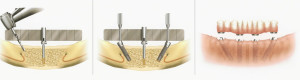 Tratamiento en mandíbula, con los implantes distales inclinados