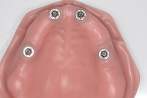 Tratamiento con 4implantes dentales para prótesis fija