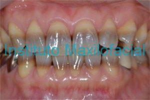 Dentes manchados de tetraciclina