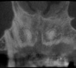 Situación prequirúrgica, atrofia ósea alveolar en maxilar superior,