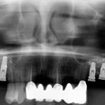 Elevación de seno maxilar que permite la colocación de implantes dentales