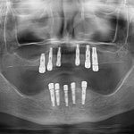 Tratamiento con Implantes para prótesis Hibrida. All on six en maxilar superior y All on four para la mandibula